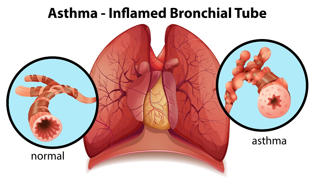 asthma-inflamed.bronchial.tube