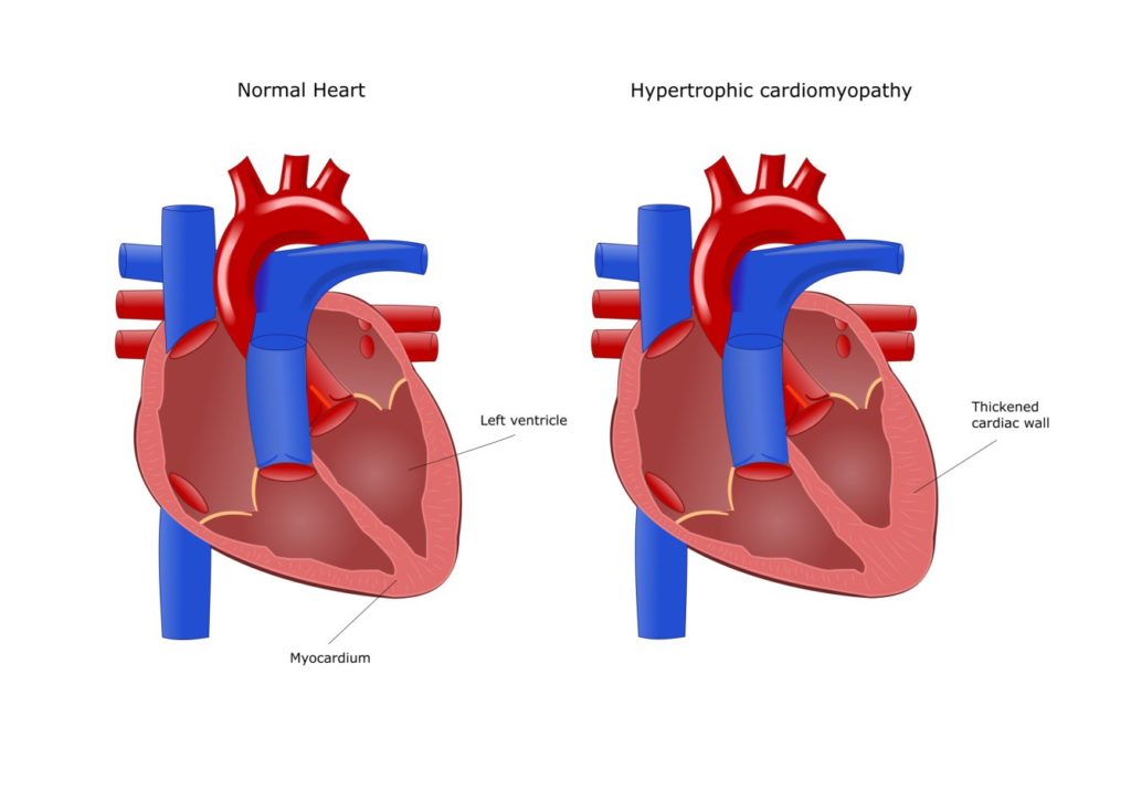 normal-vs-hypertrophic-heart